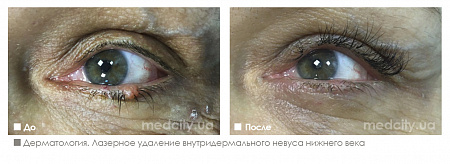 Удаление невуса фото до и после процедуры