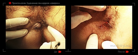 Удаление геморроя лазером 11 фото до и после процедуры