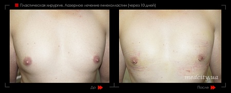 Гинекомастия 50 фото до и после процедуры