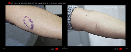 Лазерное удаление липомы 18 фото до и после процедуры