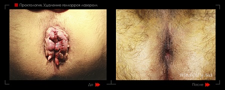 Удаление геморроя лазером 19 фото до и после процедуры