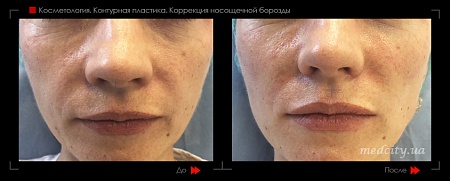 Контурная пластика носощечной борозды фото до и после процедуры