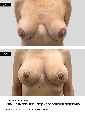 Замена грудных имплантов6 фото до и после процедуры