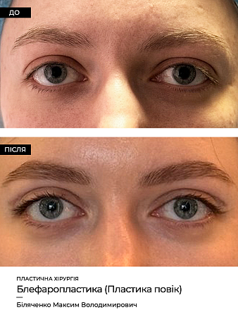 Блефаропластика фото до и после процедуры