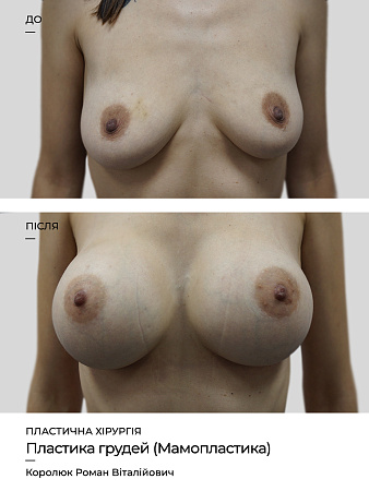 Мамопластика фото до и после процедуры