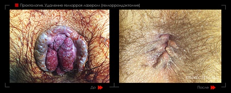 Удаление геморроя лазером 26 фото до и после процедуры