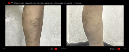 Эндоваскулярная лазерная коагуляция8 фото до и после процедуры