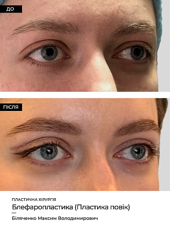 Блефаропластика фото до и после процедуры