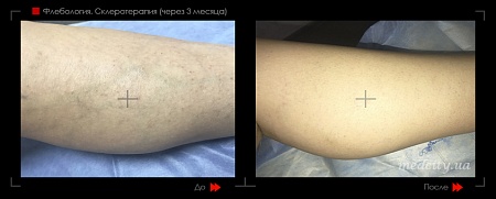 Склеротерапия 19 фото до и после процедуры
