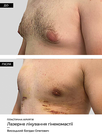 Гинекомастия 32 фото до и после процедуры