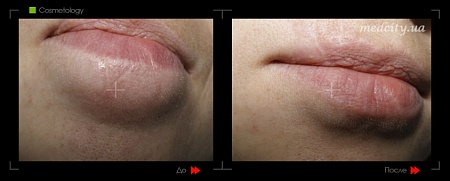 Шлифовка рубца3 фото до и после процедуры