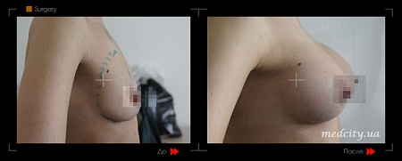Mammoplastika 11 фото до и после процедуры