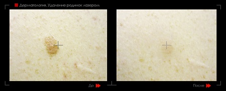 Удаление родинок 37 фото до и после процедуры