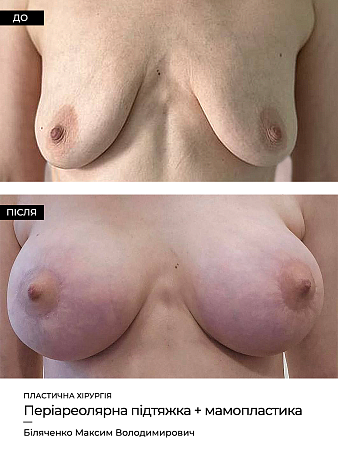Mammoplastika 11 фото до и после процедуры