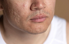 Как навсегда убрать атрофические рубцы