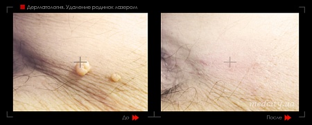 Удаление родинок 35 фото до и после процедуры