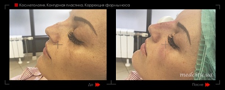 Контурная пластика носа 4 фото до и после процедуры