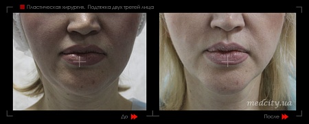 Подтяжка лица 3 фото до и после процедуры