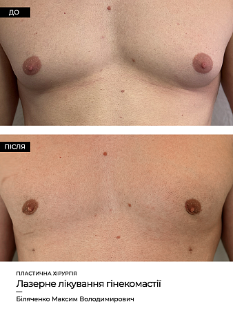 Гинекомастия 44 фото до и после процедуры