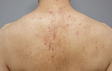 Лечение кератоза