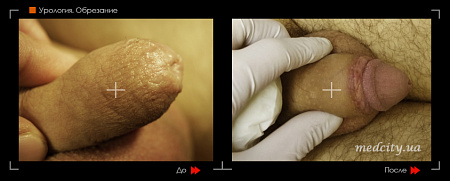 Лазерное обрезание крайней плоти фото до и после процедуры
