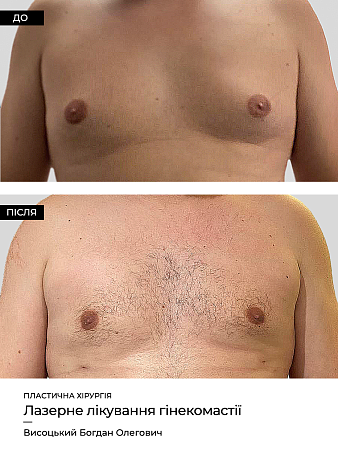 Гинекомастия 7 фото до и после процедуры
