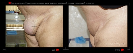 Подтяжка лобка фото до и после процедуры