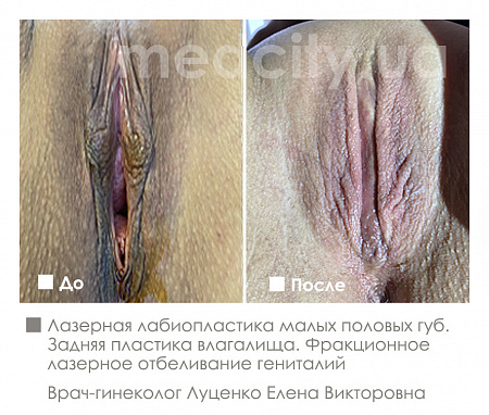 Лазерная лабиопластика малых половых губ. Задняя пластика влагалища  фото до и после процедуры