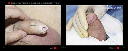 Лазерное обрезание крайней плоти 2 фото до и после процедуры