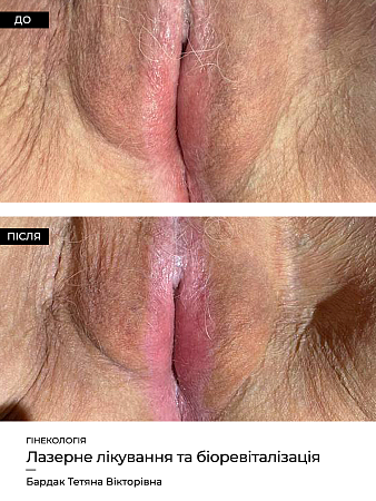 Лазерне лікування  фото до и после процедуры