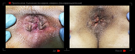 Удаление геморроя лазером 25 фото до и после процедуры
