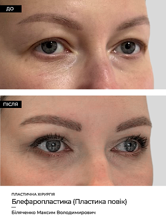 Блефаропластика нижних век фото до и после процедуры