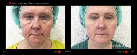 Фотоомоложение 2 фото до и после процедуры