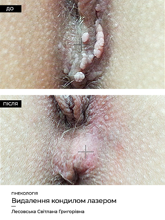 Удаление кондилом (гинек.) 6 фото до и после процедуры
