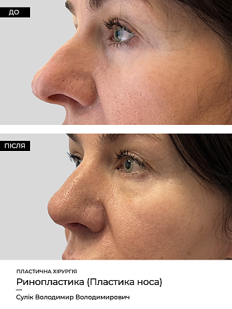 Ринопластика 22 фото до и после процедуры