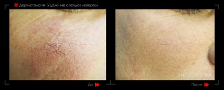 Лазерное удаление сосудов 22 фото до и после процедуры