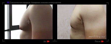 Гинекомастия 11 фото до и после процедуры