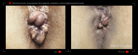 Удаление геморроя лазером 27 фото до и после процедуры