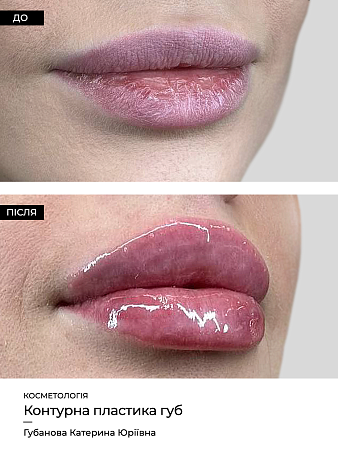 Увеличение губ 69 фото до и после процедуры