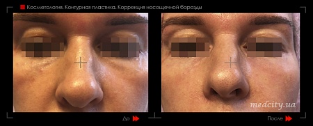 Контурная пластика носощечной борозды2 фото до и после процедуры