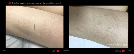 Склеротерапия 19 фото до и после процедуры