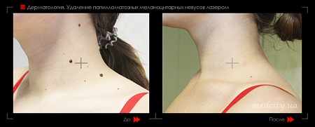 Лазерное удаление невуса 9 фото до и после процедуры