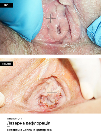 Дефлорация фото до и после процедуры