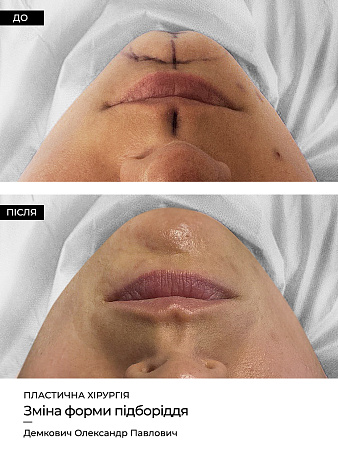 Зміна форми підборіддя фото до и после процедуры