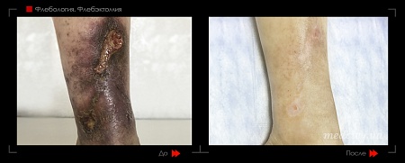 Флебэктомия4 фото до и после процедуры