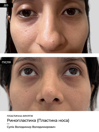 Ринопластика 19 фото до и после процедуры