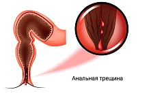Как быстро вылечить трещину в заднем проходе