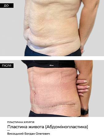Абдомінопластика фото до и после процедуры