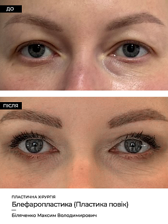 Блефаропластика фото до и после процедуры