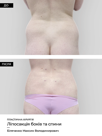 Ліпосакція спини фото до и после процедуры